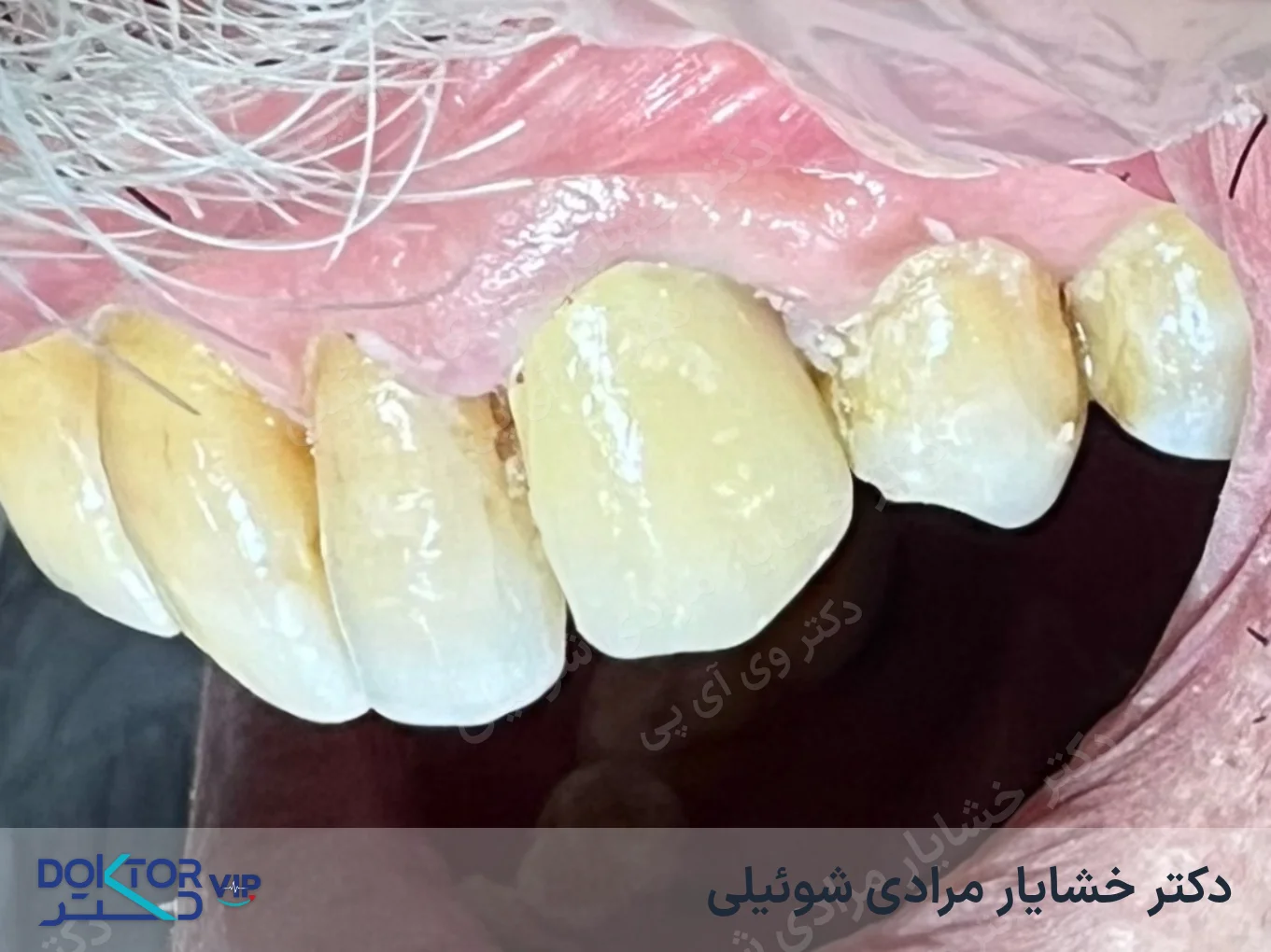 بعد از درمان