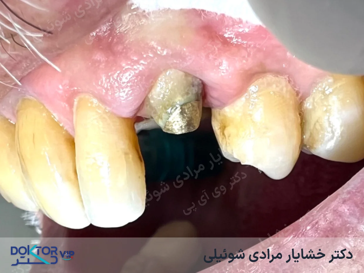 قبل از درمان