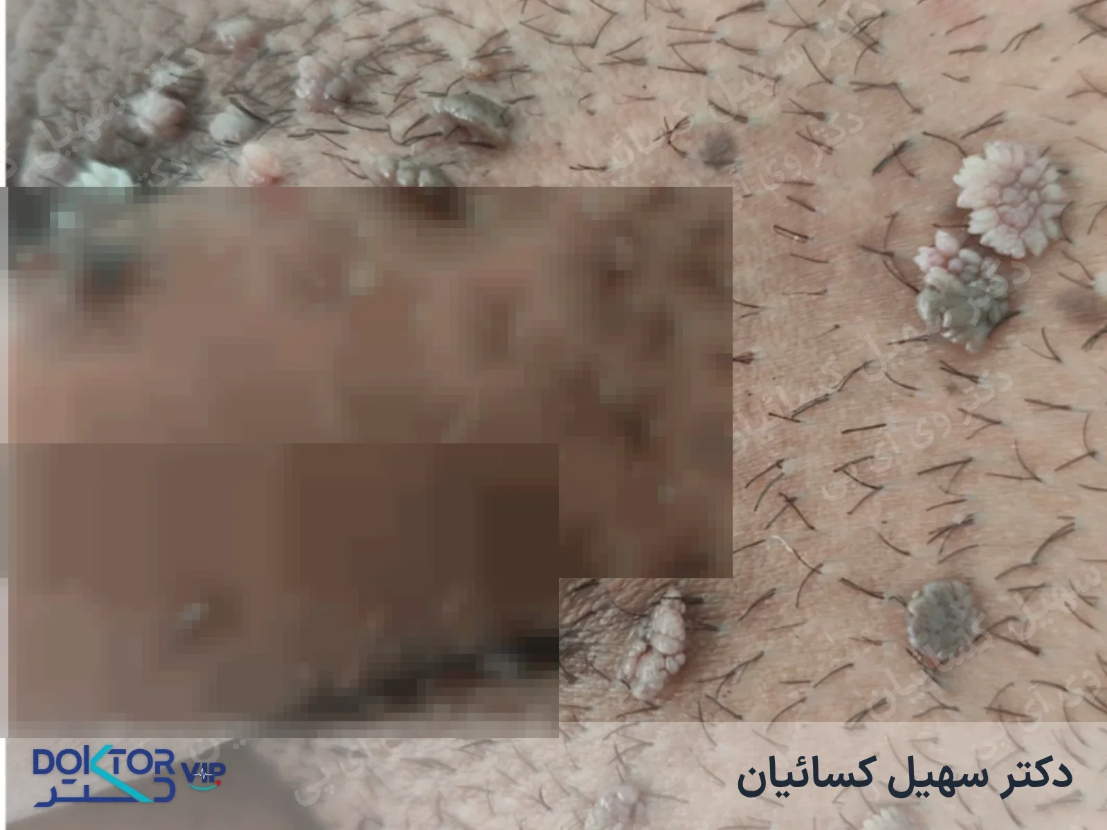 قبل از درمان