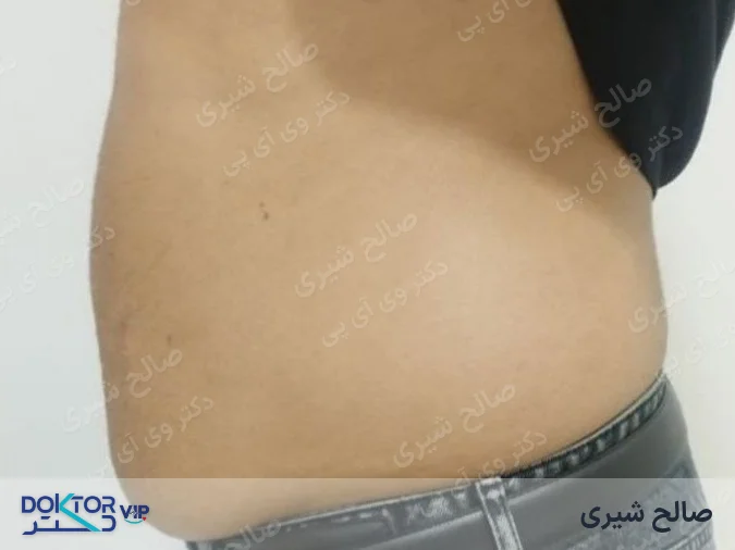 بعد از درمان