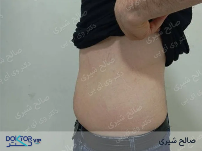 بعد از درمان