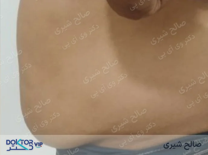 قبل از درمان