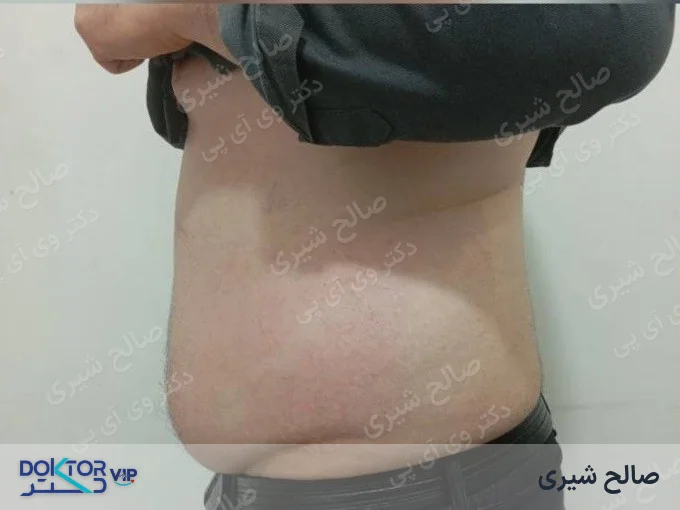 قبل از درمان